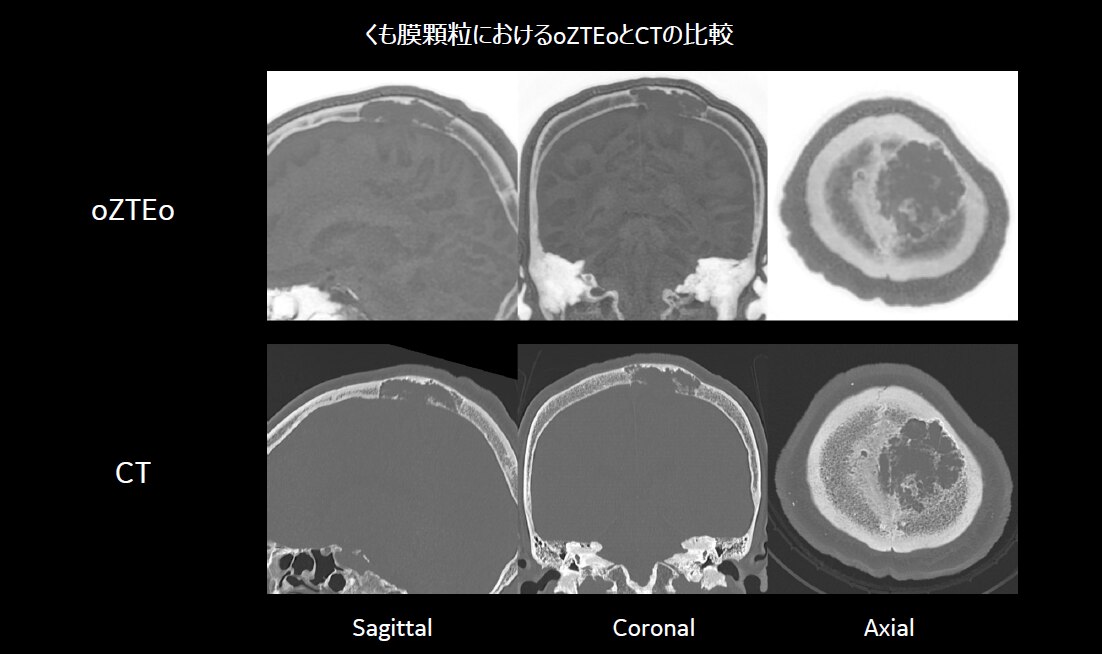 脳神経外科領域におけるMR Bone imaging : oZTEoの活用法 | GE